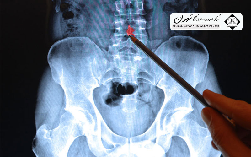 مزایای انجام MRI کمر