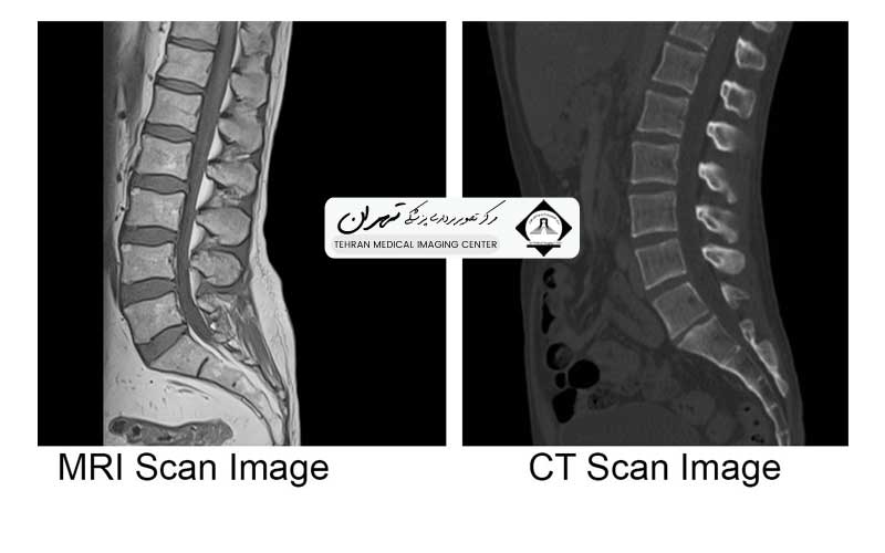 هزینه ام آر آی دیسک کمر