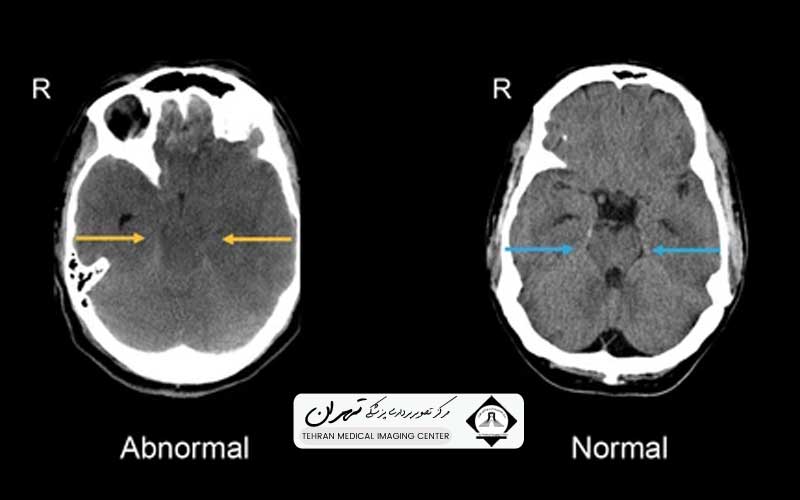 هزینه سی تی اسکن مغز