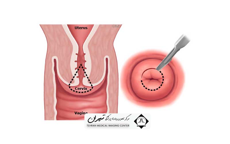 هزینه نمونه برداری از رحم