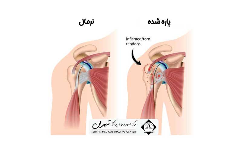 هزینه ام آر آی کتف 7 مراحل انجام ام آر آی کتف و تأثیر آن بر هزینه