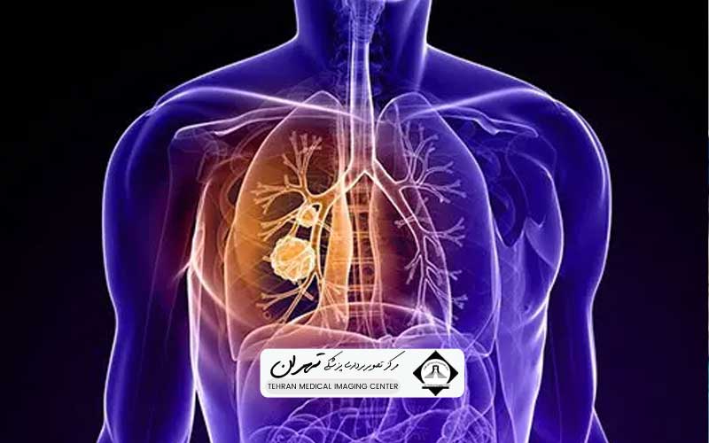 سی‌تی‌اسکن ریه چیست و کاربردهای آن