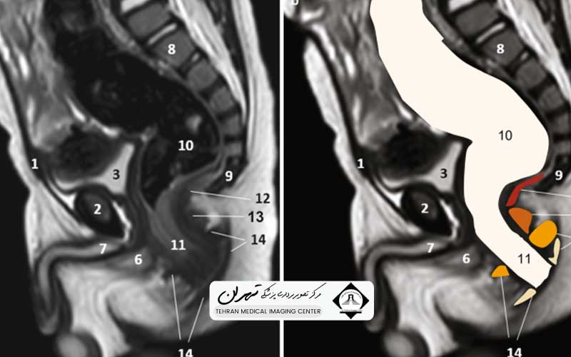 ام آر آی کمر و لگن 3 ام آر آی کمر و لگن چیست