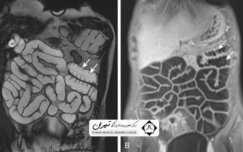 ام ار ای انتروگرافی