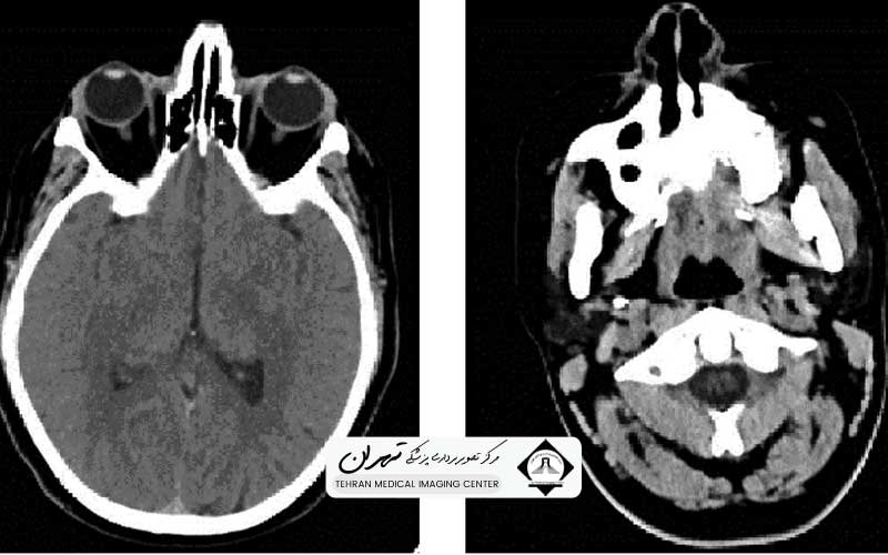 عکس سی تی اسکن مغز سالم 3 سی تی اسکن مغز سالم